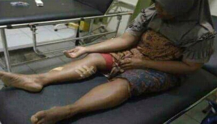 Korban Wati (40) warga Pekon Sripurnomo, Semaka, Tanggamus digigit buaya kaki kanannya sedang menjalani perawatan.(koesma)